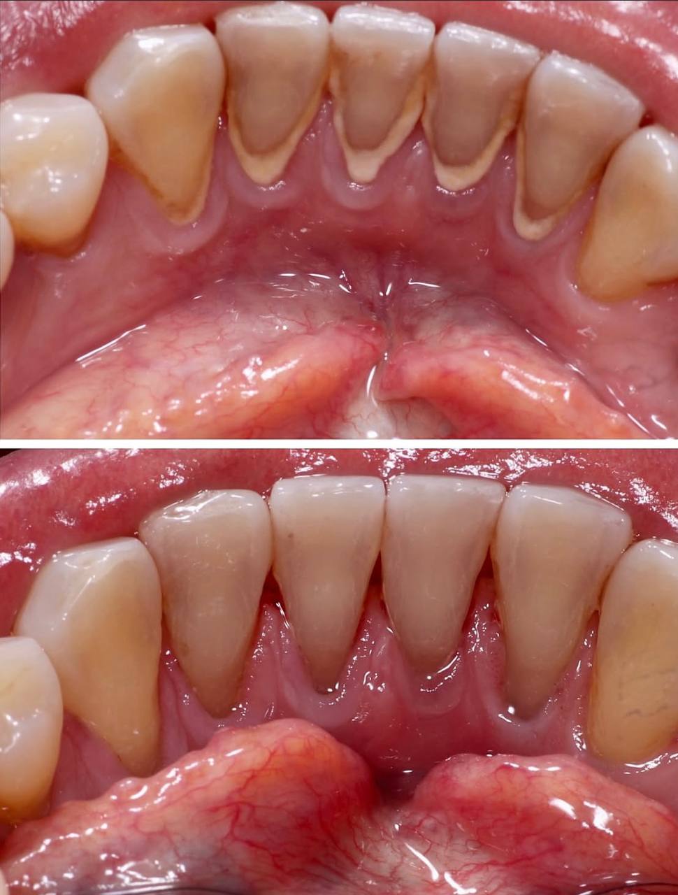 Antes y Después - Caso 2